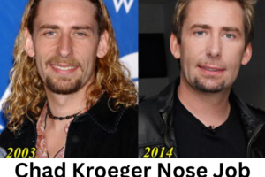 Chad Kroeger Nose Job