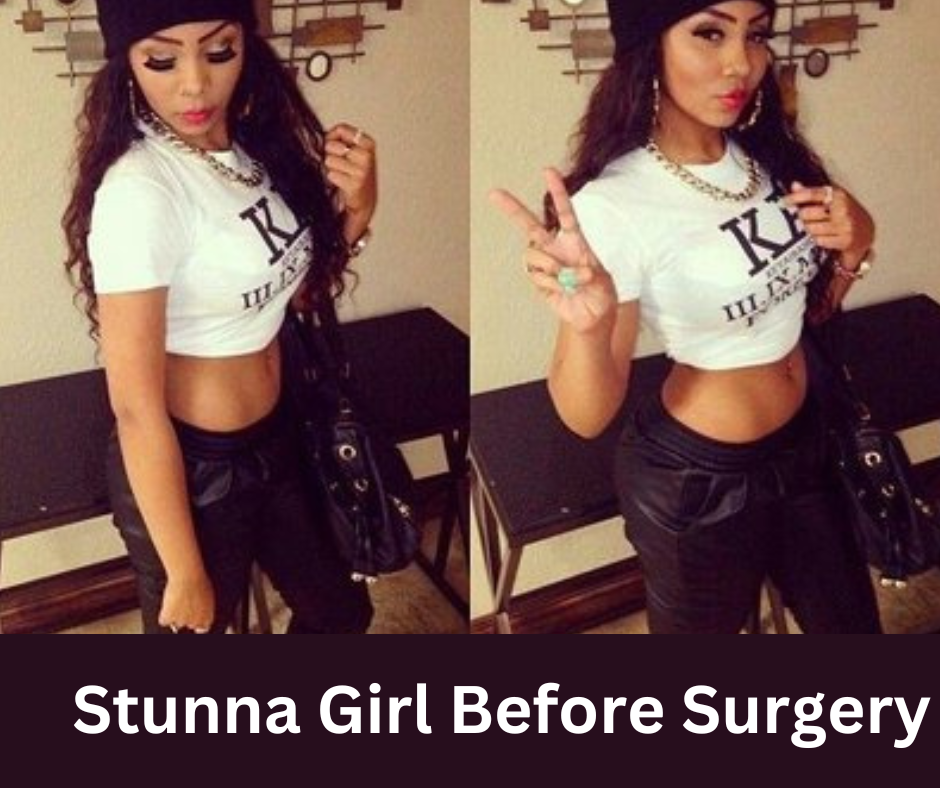 Stunna Girl Before Surgery: A Journey of Transformation Endowment ...