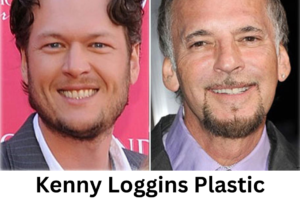 Kenny Loggins Plastic Surgery