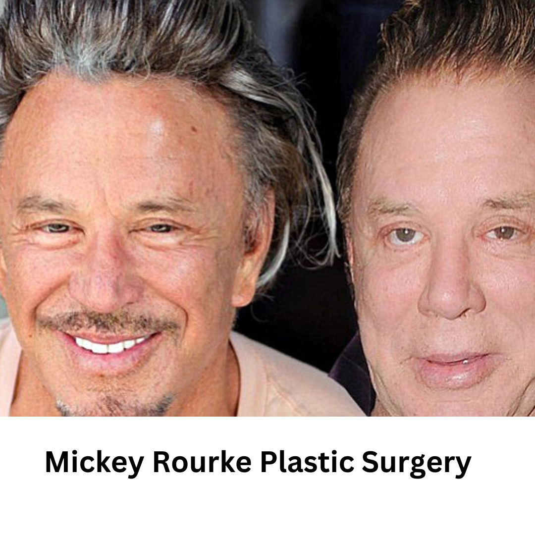 Mickey Rourke Plastic Surgery: The Transformation of a Hollywood Icon ...