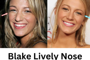 Blake Lively Nose Job