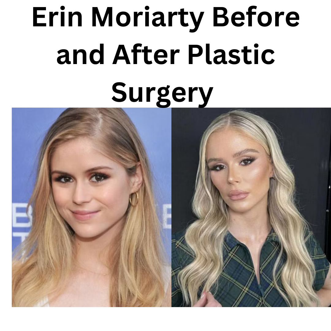 Erin Moriarty Before and After Plastic Surgery Journey A Comprehensive