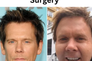 Kevin Bacon Plastic Surgery