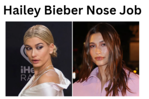 Hailey Bieber Nose Job