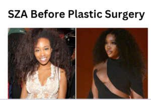 SZA Before Plastic Surgery